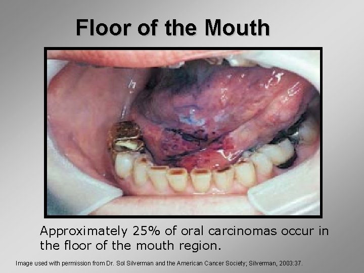 Floor of the Mouth Approximately 25% of oral carcinomas occur in the floor of