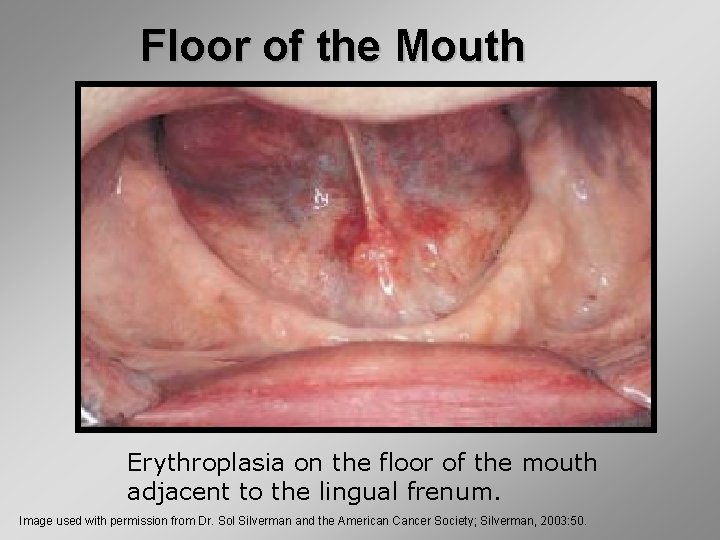 Floor of the Mouth Erythroplasia on the floor of the mouth adjacent to the