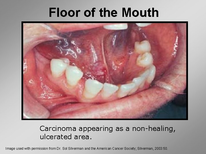 Floor of the Mouth Carcinoma appearing as a non-healing, ulcerated area. Image used with