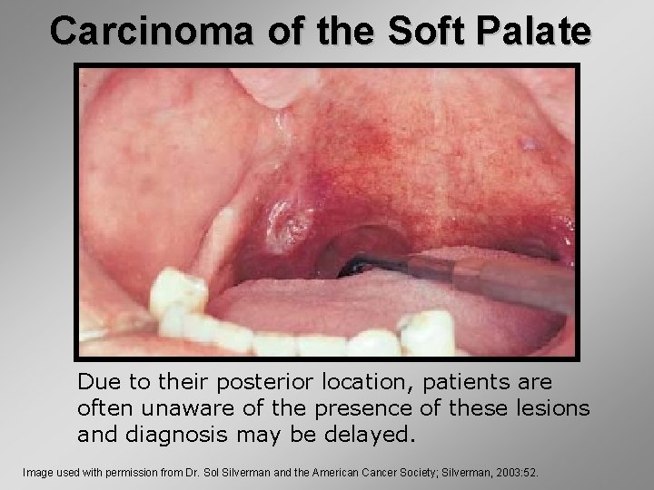 Carcinoma of the Soft Palate Due to their posterior location, patients are often unaware