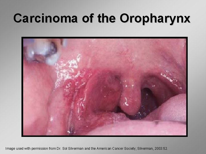 Carcinoma of the Oropharynx Image used with permission from Dr. Sol Silverman and the