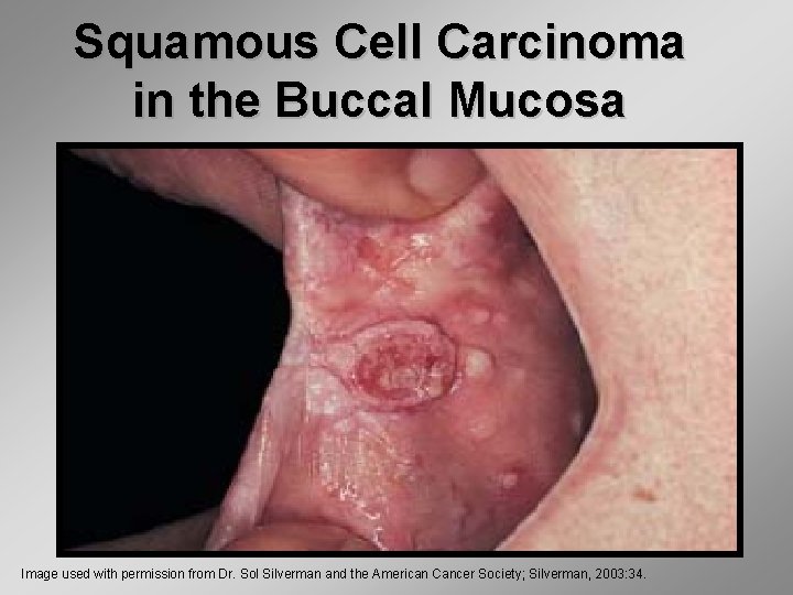 Squamous Cell Carcinoma in the Buccal Mucosa Image used with permission from Dr. Sol