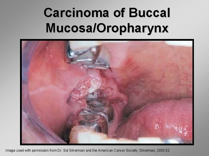 Carcinoma of Buccal Mucosa/Oropharynx Image used with permission from Dr. Sol Silverman and the