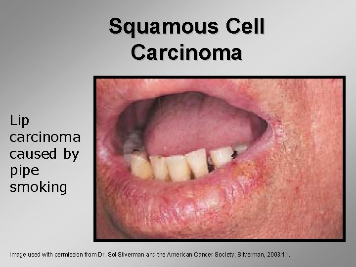 Squamous Cell Carcinoma Lip carcinoma caused by pipe smoking Image used with permission from
