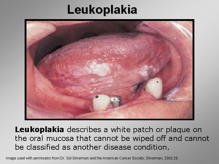 Leukoplakia describes a white patch or plaque on the oral mucosa that cannot be