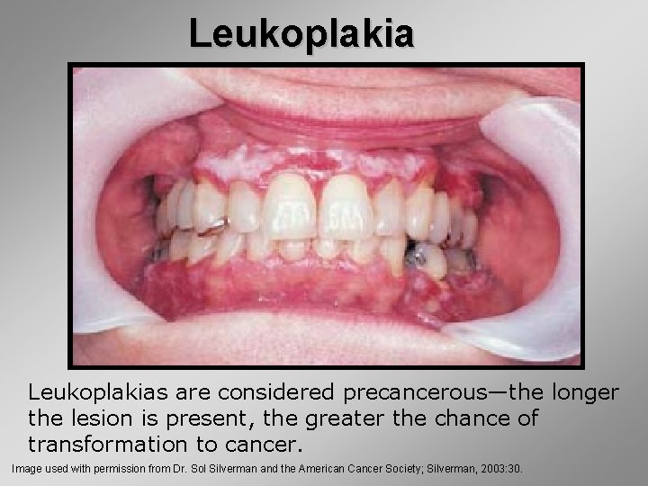 Leukoplakias are considered precancerous—the longer the lesion is present, the greater the chance of