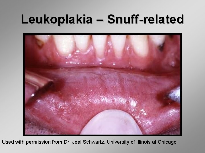 Leukoplakia – Snuff-related Used with permission from Dr. Joel Schwartz, University of Illinois at