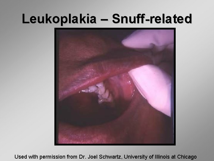 Leukoplakia – Snuff-related Used with permission from Dr. Joel Schwartz, University of Illinois at