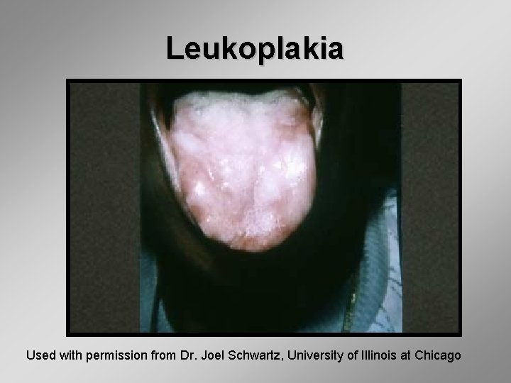 Leukoplakia Used with permission from Dr. Joel Schwartz, University of Illinois at Chicago 