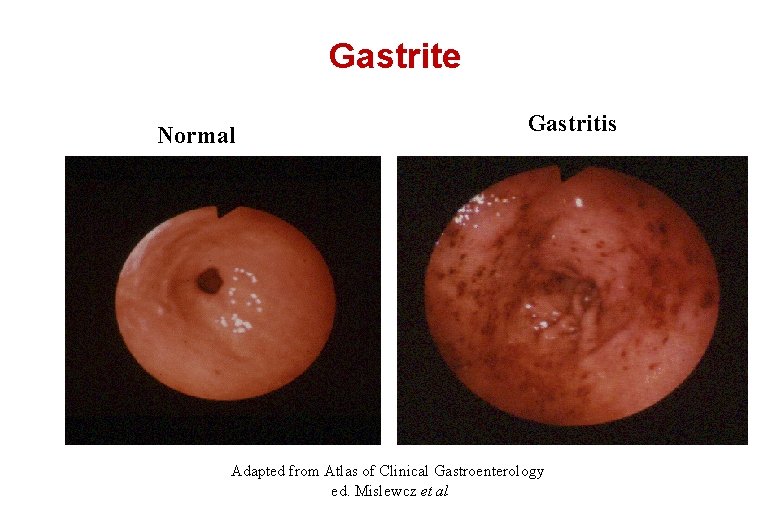 Gastrite Normal Gastritis Adapted from Atlas of Clinical Gastroenterology ed. Mislewcz et al 