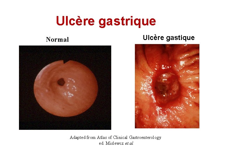 Ulcère gastrique Normal Ulcère gastique Adapted from Atlas of Clinical Gastroenterology ed. Mislewcz et