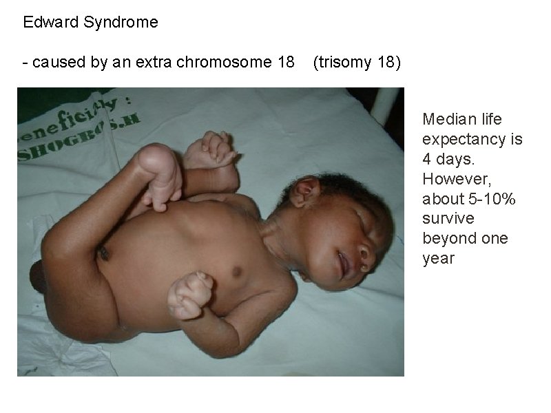 Edward Syndrome - caused by an extra chromosome 18 (trisomy 18) Median life expectancy