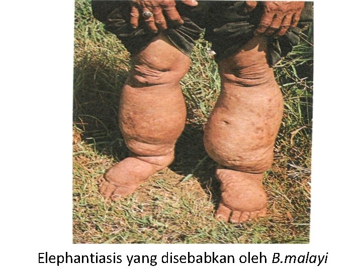 Elephantiasis yang disebabkan oleh B. malayi Elephantiasis yang disebabkan oleh B. malayi