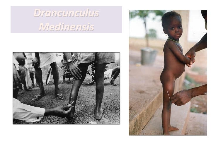Drancunculus Medinensis Drancunculus Medinensis