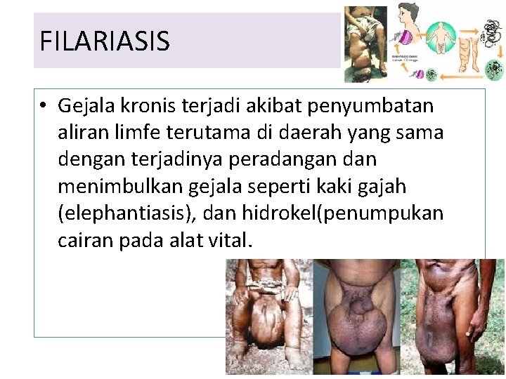 FILARIASIS • Gejala kronis terjadi akibat penyumbatan aliran limfe terutama di daerah yang sama FILARIASIS • Gejala kronis terjadi akibat penyumbatan aliran limfe terutama di daerah yang sama