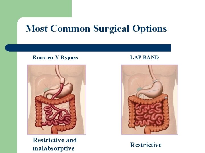 Most Common Surgical Options Gastric Bypass (GBP) LAP-BAND System Roux-en-Y Bypass LAP BAND Restrictive