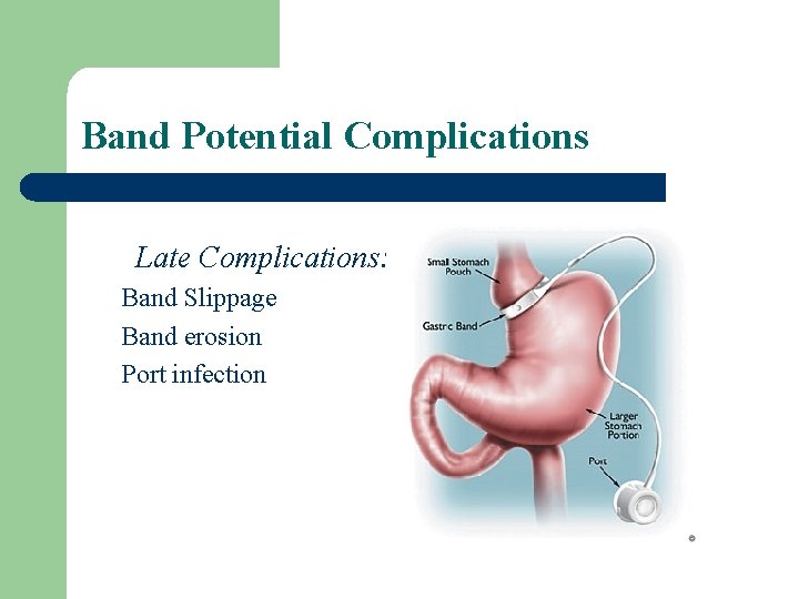 Band Potential Complications Late Complications: Band Slippage Band erosion Port infection 