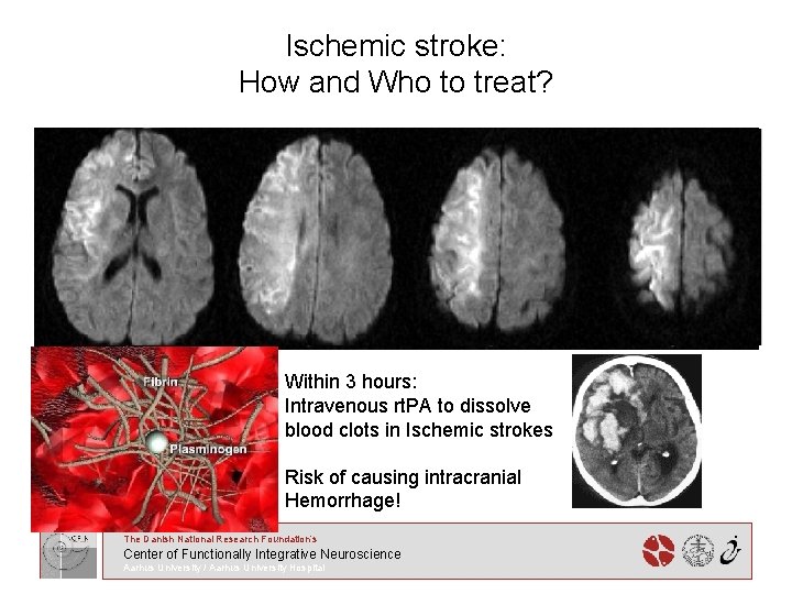 Ischemic stroke: How and Who to treat? Within 3 hours: Intravenous rt. PA to