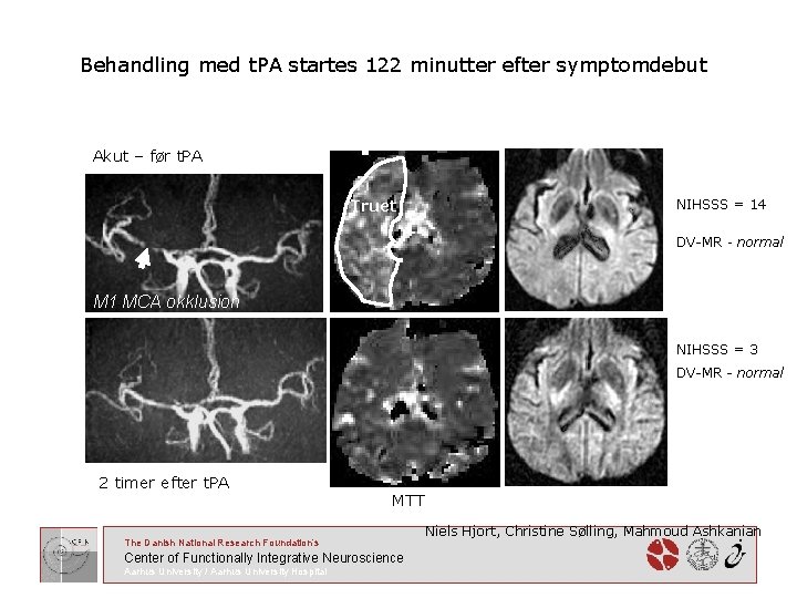 Behandling med t. PA startes 122 minutter efter symptomdebut Akut – før t. PA