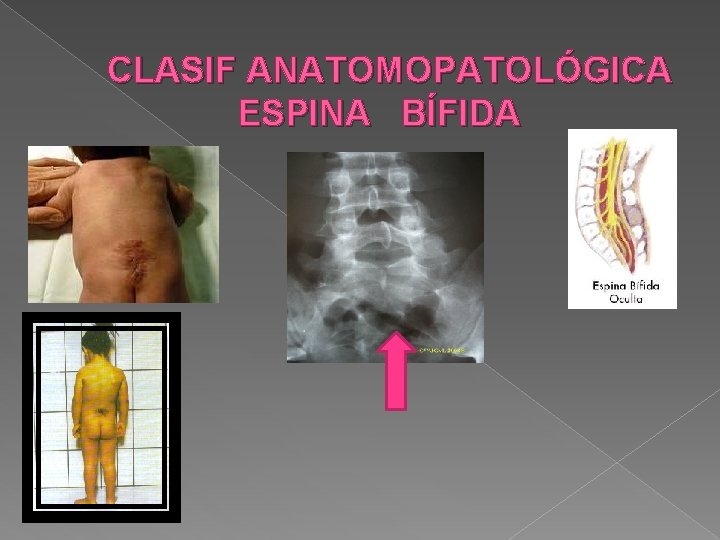CLASIF ANATOMOPATOLÓGICA ESPINA BÍFIDA CLASIF ANATOMOPATOLÓGICA ESPINA BÍFIDA