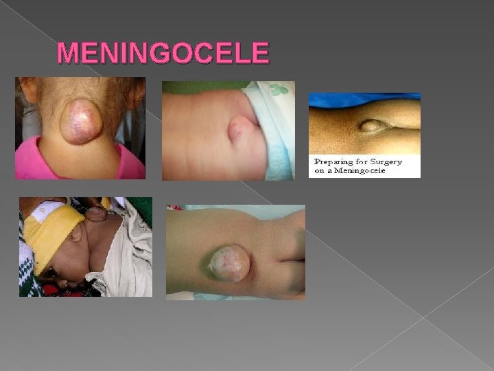 MENINGOCELE MENINGOCELE