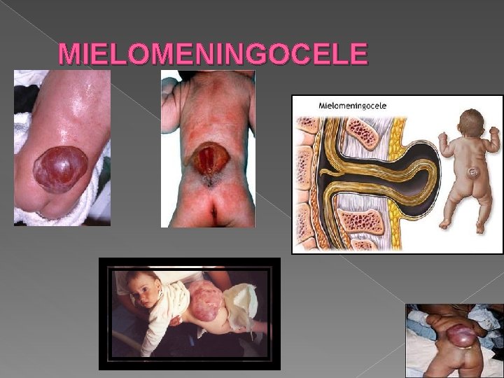 MIELOMENINGOCELE MIELOMENINGOCELE