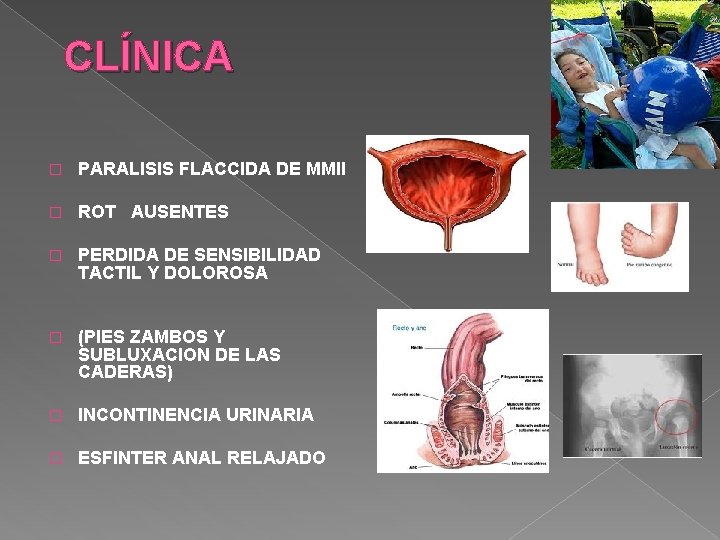 CLÍNICA � PARALISIS FLACCIDA DE MMII � ROT AUSENTES � PERDIDA DE SENSIBILIDAD TACTIL CLÍNICA � PARALISIS FLACCIDA DE MMII � ROT AUSENTES � PERDIDA DE SENSIBILIDAD TACTIL