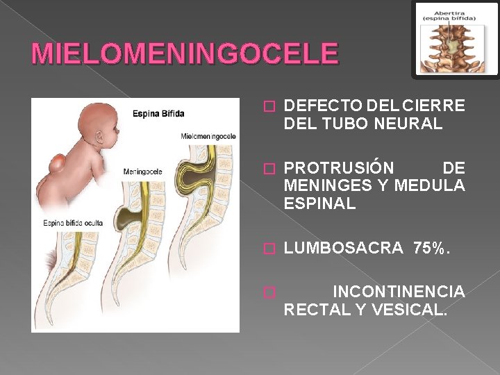 MIELOMENINGOCELE � DEFECTO DEL CIERRE DEL TUBO NEURAL � PROTRUSIÓN DE MENINGES Y MEDULA MIELOMENINGOCELE � DEFECTO DEL CIERRE DEL TUBO NEURAL � PROTRUSIÓN DE MENINGES Y MEDULA