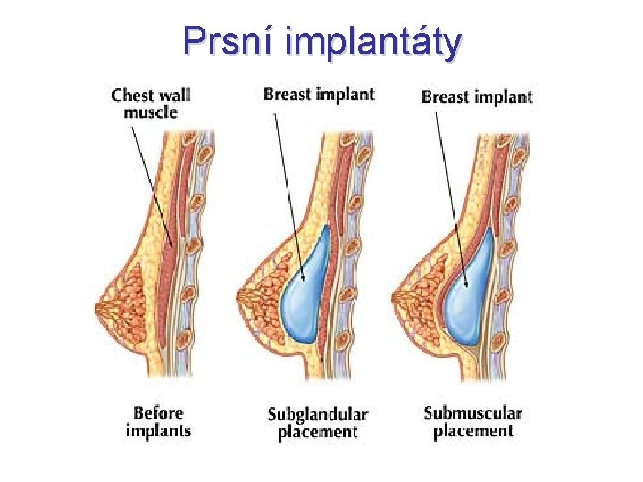 Prsní implantáty 