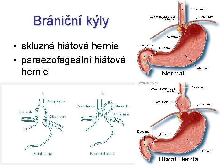 Brániční kýly • skluzná hiátová hernie • paraezofageální hiátová hernie 
