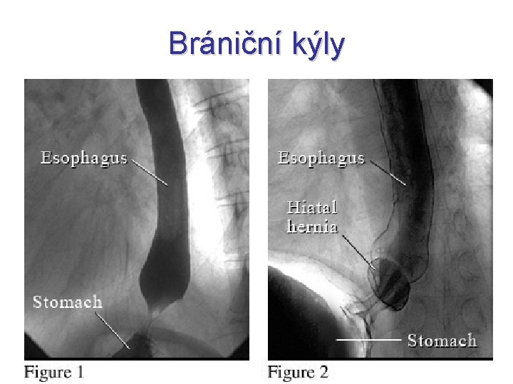 Brániční kýly 