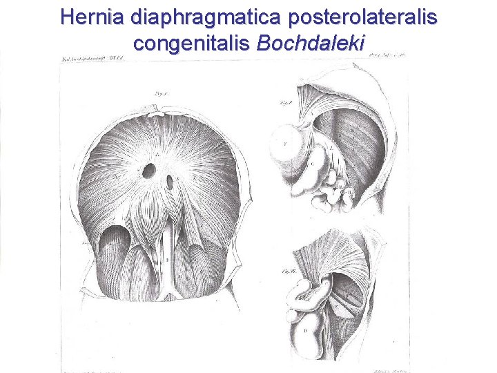Hernia diaphragmatica posterolateralis congenitalis Bochdaleki 