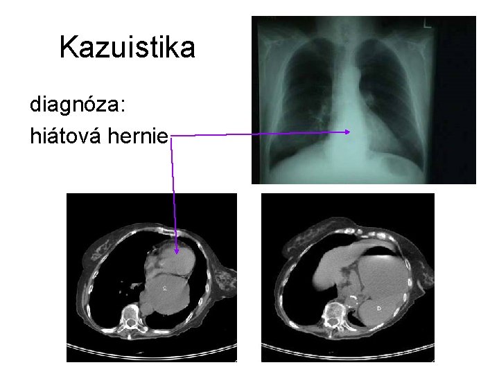 Kazuistika diagnóza: hiátová hernie 