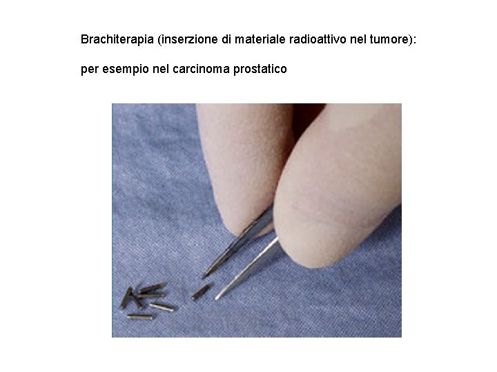Brachiterapia (inserzione di materiale radioattivo nel tumore): per esempio nel carcinoma prostatico Brachiterapia (inserzione di materiale radioattivo nel tumore): per esempio nel carcinoma prostatico