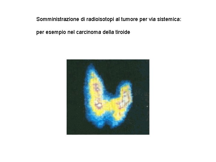 Somministrazione di radioisotopi al tumore per via sistemica: per esempio nel carcinoma della tiroide Somministrazione di radioisotopi al tumore per via sistemica: per esempio nel carcinoma della tiroide