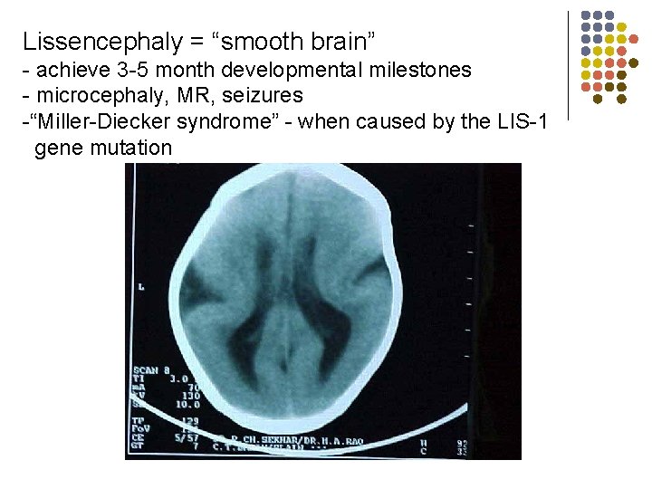 Lissencephaly = “smooth brain” - achieve 3 -5 month developmental milestones - microcephaly, MR,