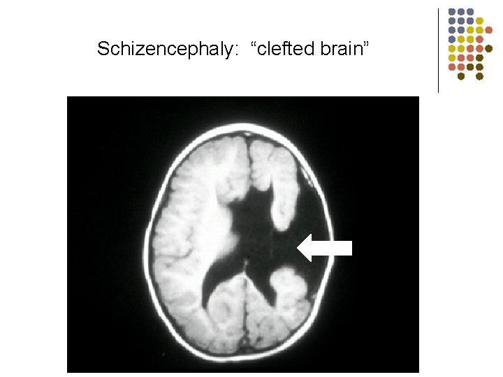 Schizencephaly: “clefted brain” 