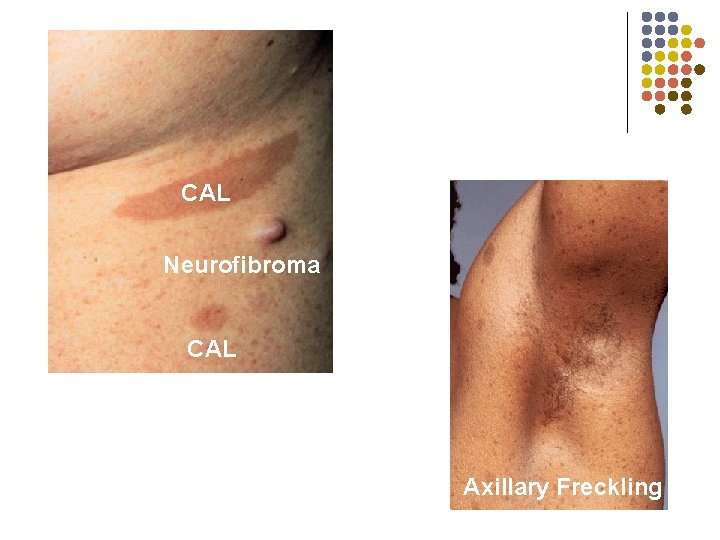 CAL Neurofibroma CAL Axillary Freckling 