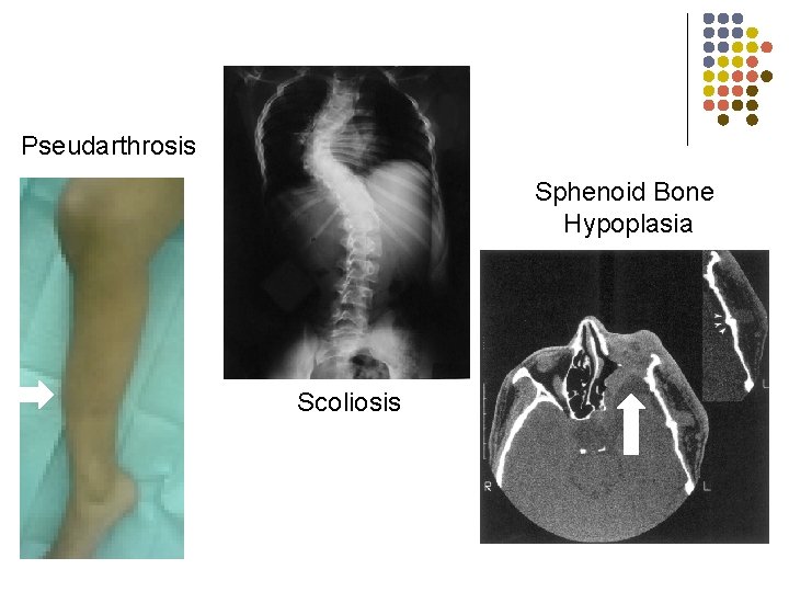 Pseudarthrosis Sphenoid Bone Hypoplasia Scoliosis 