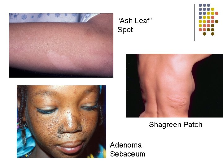 “Ash Leaf” Spot Shagreen Patch Adenoma Sebaceum 