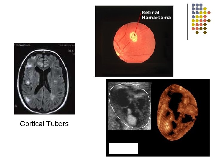 Cortical Tubers Rhabdomyoma 