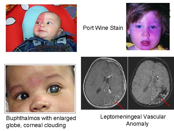 Port Wine Stain Buphthalmos with enlarged globe, corneal clouding Leptomeningeal Vascular Anomaly 