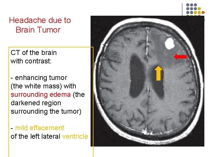 Headache due to Brain Tumor CT of the brain with contrast: - enhancing tumor