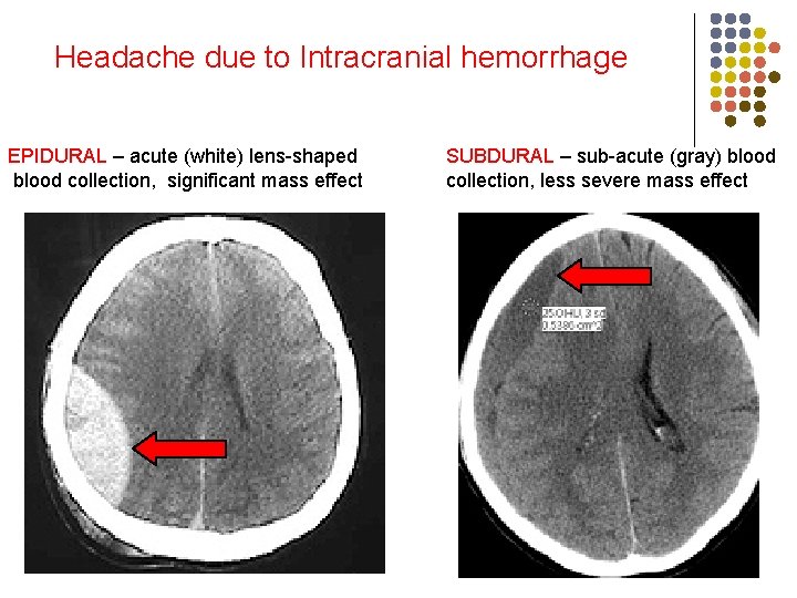 Headache due to Intracranial hemorrhage EPIDURAL – acute (white) lens-shaped blood collection, significant mass