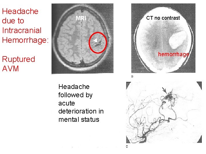 Headache due to Intracranial Hemorrhage: MRI CT no contrast hemorrhage Ruptured AVM Headache followed