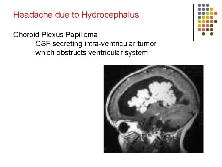 Headache due to Hydrocephalus Choroid Plexus Papilloma CSF secreting intra-ventricular tumor which obstructs ventricular