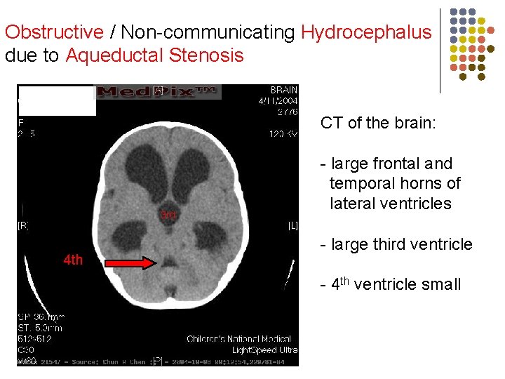 Obstructive / Non-communicating Hydrocephalus due to Aqueductal Stenosis CT of the brain: 3 rd