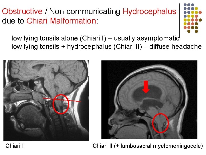 Obstructive / Non-communicating Hydrocephalus due to Chiari Malformation: low lying tonsils alone (Chiari I)