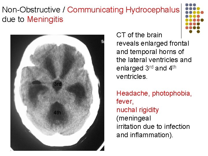 Non-Obstructive / Communicating Hydrocephalus due to Meningitis CT of the brain reveals enlarged frontal