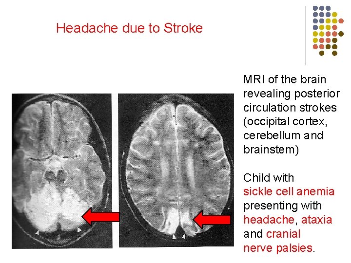 Headache due to Stroke MRI of the brain revealing posterior circulation strokes (occipital cortex,